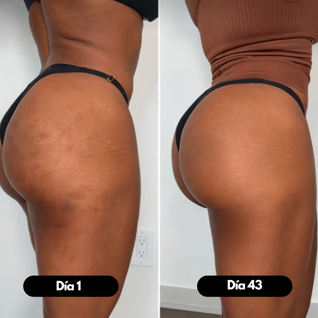 Masajeador Anticelulitis